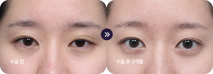 ptosis surgery guide bna