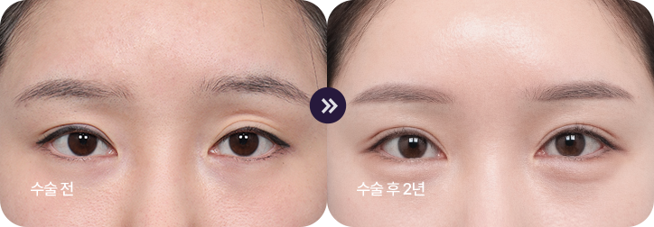 ptosis surgery guide bna2