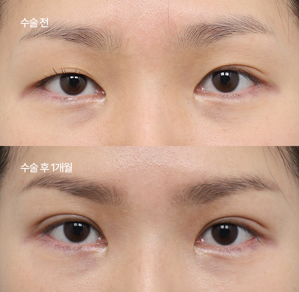 ptosis surgery guide small bna