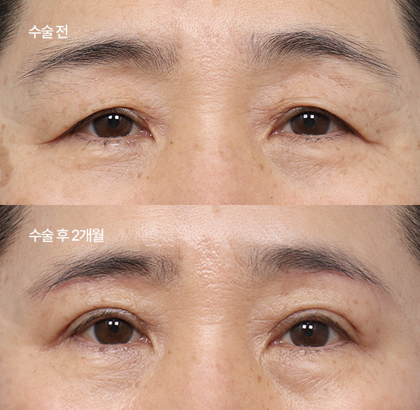 ptosis surgery guide small bna2