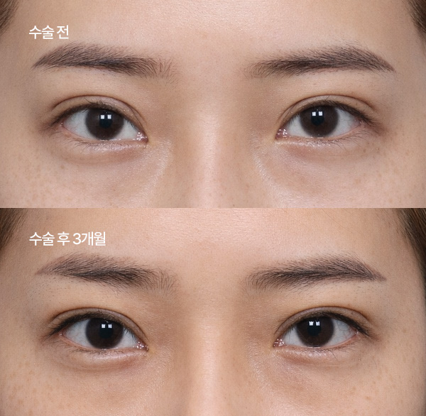ptosis surgery guide small bna3
