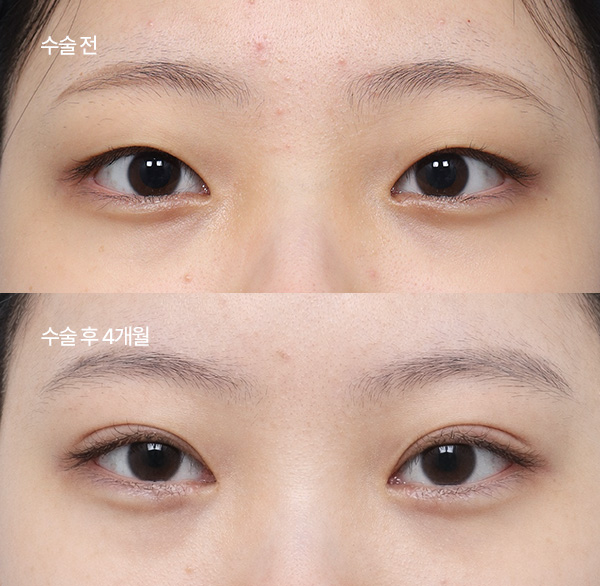 ptosis surgery guide small bna4