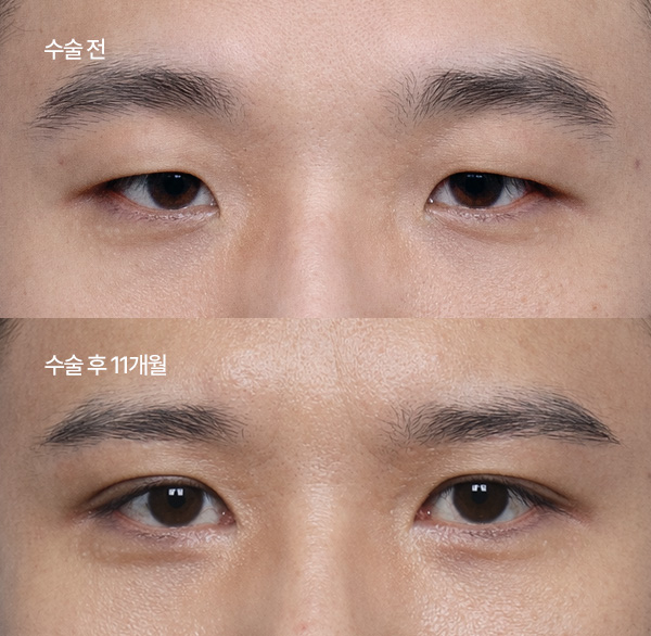 ptosis surgery guide small bna5