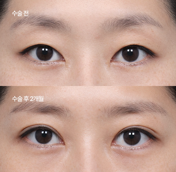 ptosis surgery guide small bna6