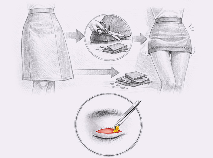 ptosis surgery step5 
