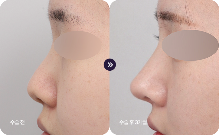 Diamond Tip Rhinoplasty bna