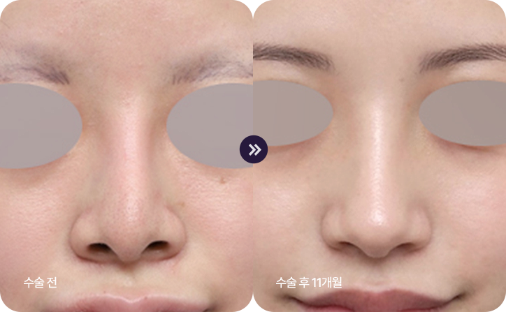 Diamond Tip Rhinoplasty bna2