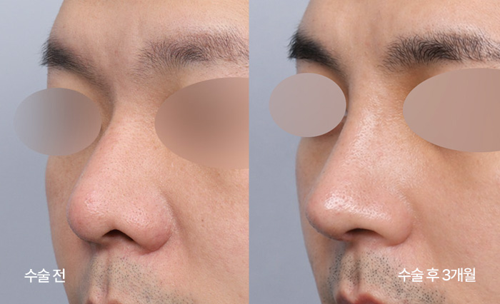 Diamond Tip Rhinoplasty small bna1