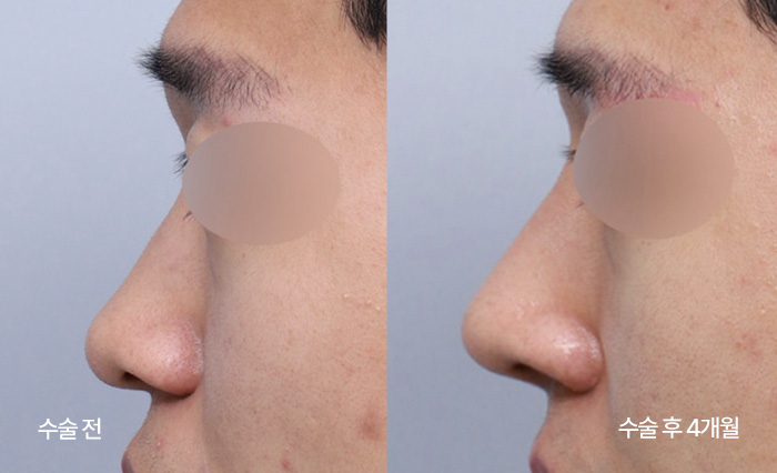 Diamond Tip Rhinoplasty small bna2