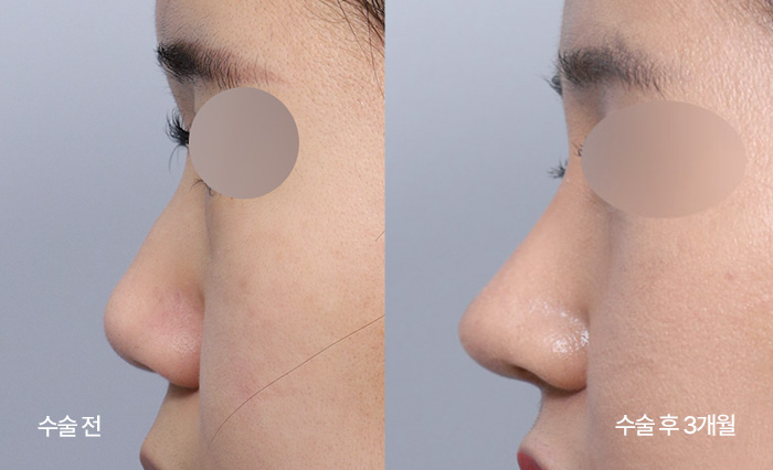 Diamond Tip Rhinoplasty small bna3