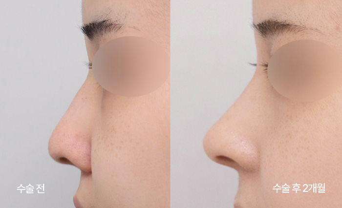 Diamond Tip Rhinoplasty small bna4