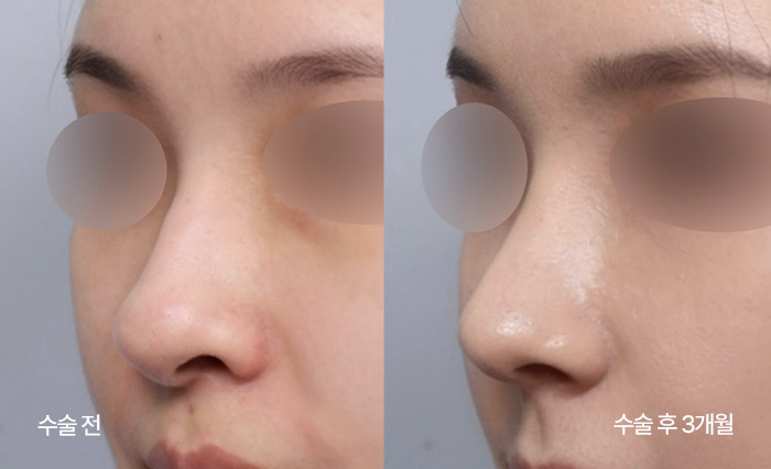 Diamond Tip Rhinoplasty small bna5