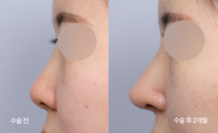 Diamond Tip Rhinoplasty small bna6