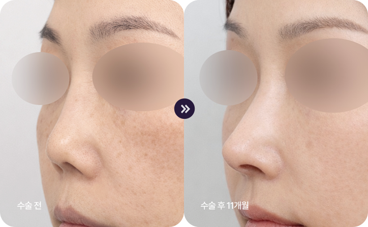 stem cell nose reconstruction bna