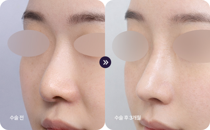 stem cell nose reconstruction bna2
