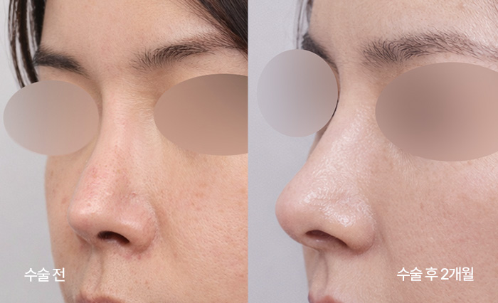 stem cell nose reconstruction small bna1