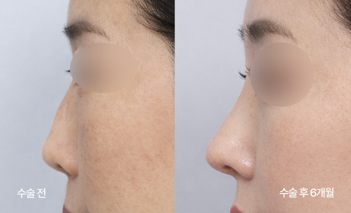 stem cell nose reconstruction small bna2
