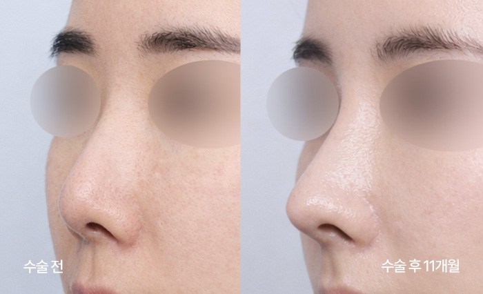 stem cell nose reconstruction small bna3