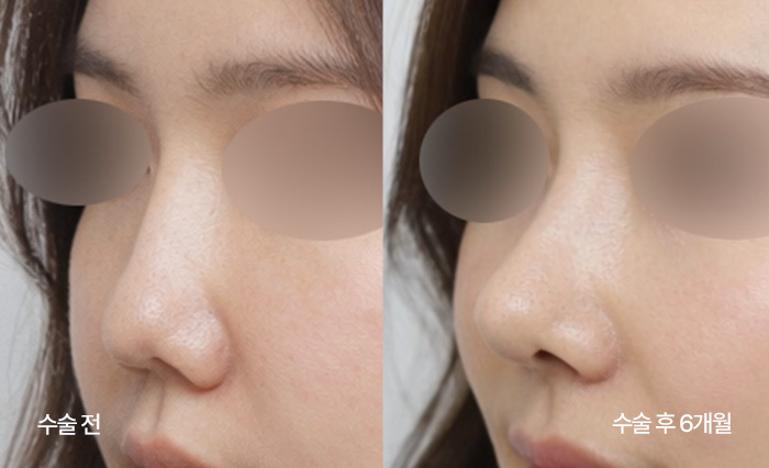stem cell nose reconstruction small bna4