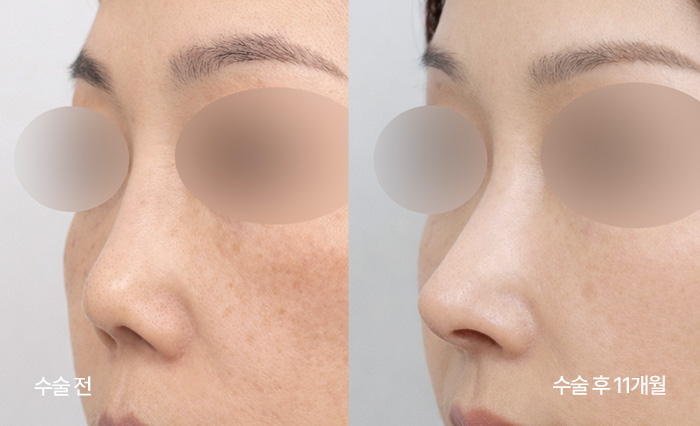 stem cell nose reconstruction small bna5
