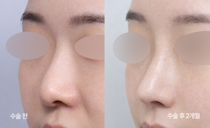 stem cell nose reconstruction small bna6